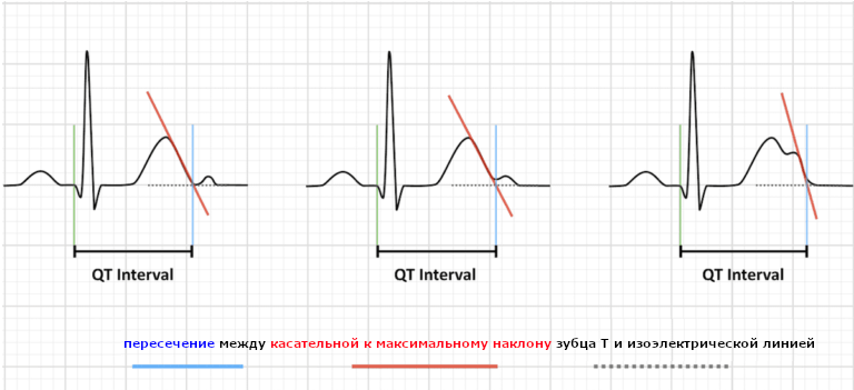 Схема определения интервала QT на кардиограмме