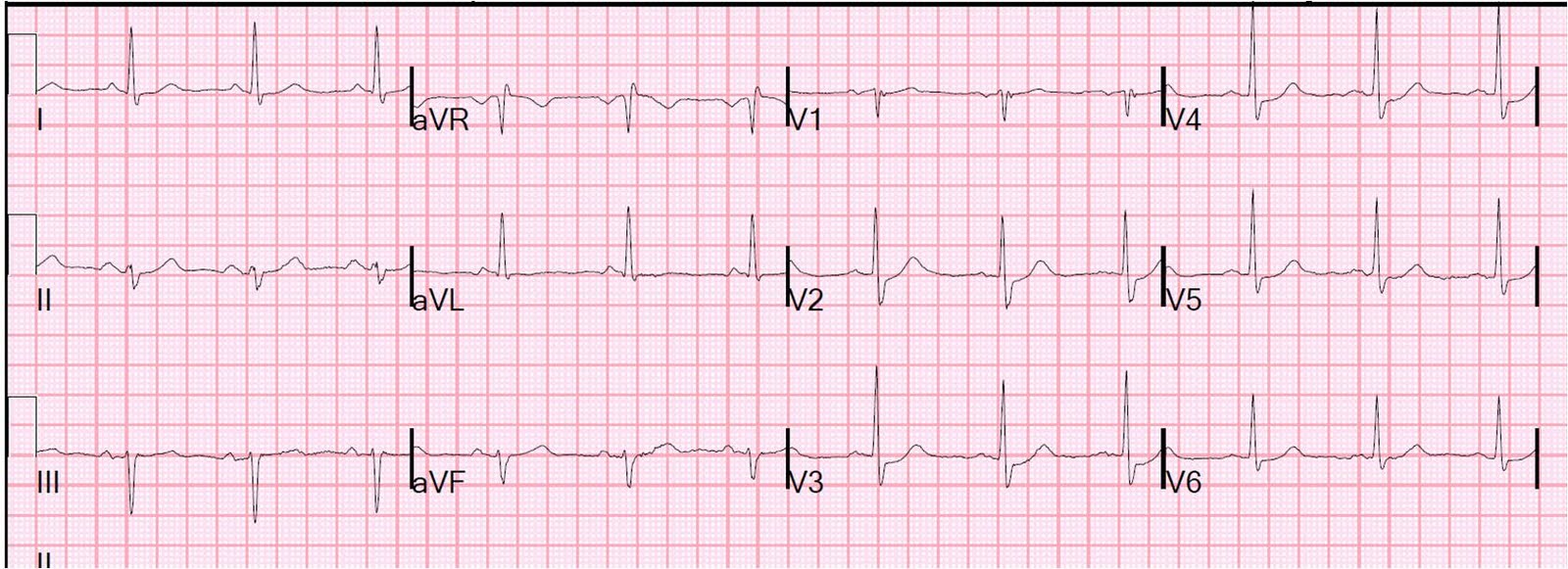 ЭКГ при инфаркте без подъема сегмента ST.