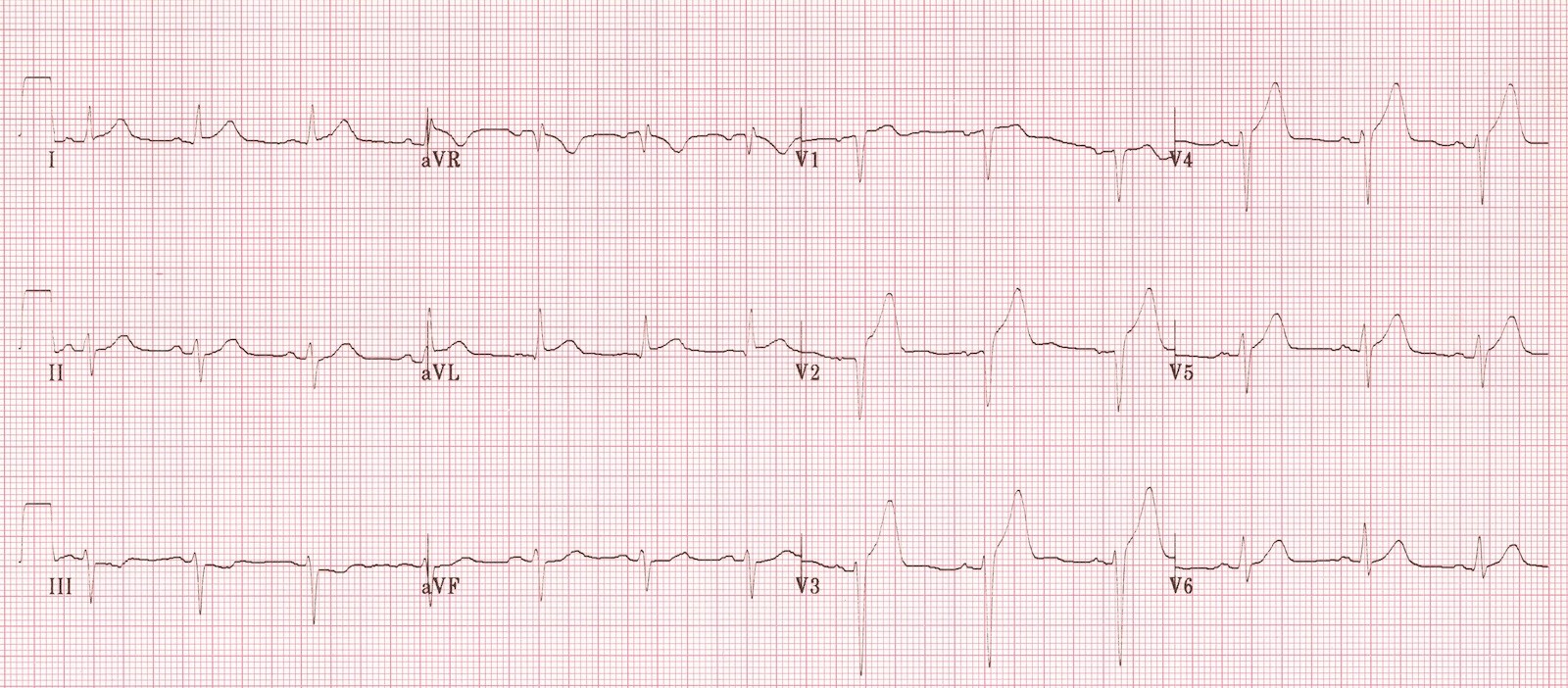 ЭКГ во время острой стадии инфаркта передней стенки и перегородки (инфаркт миокарда с подъемом ST).