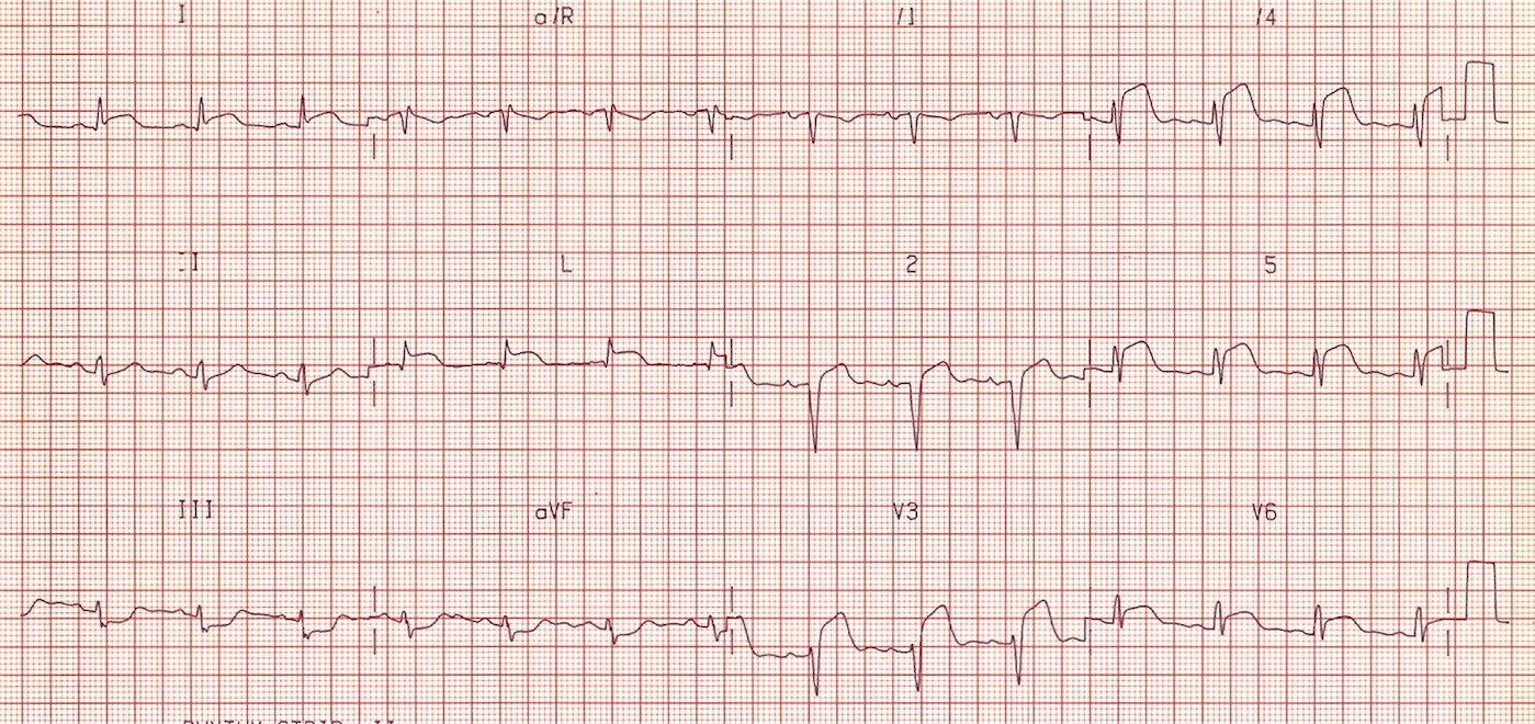 ЭКГ во время острой стадии инфаркта передней и боковой стенок левого желудочка (инфаркт миокарда с подъемом ST).