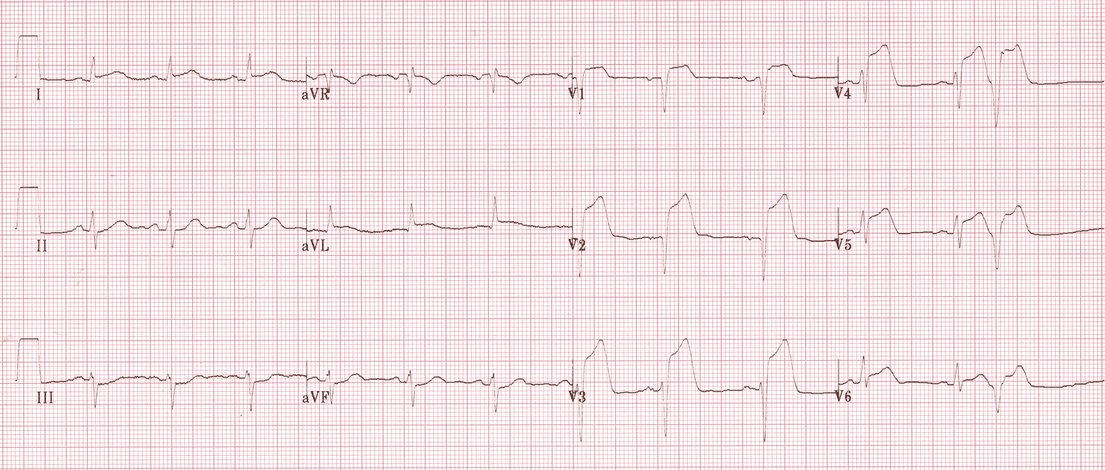 ЭКГ при распространенном инфаркте миокарда левого желудочка с подъемом ST.