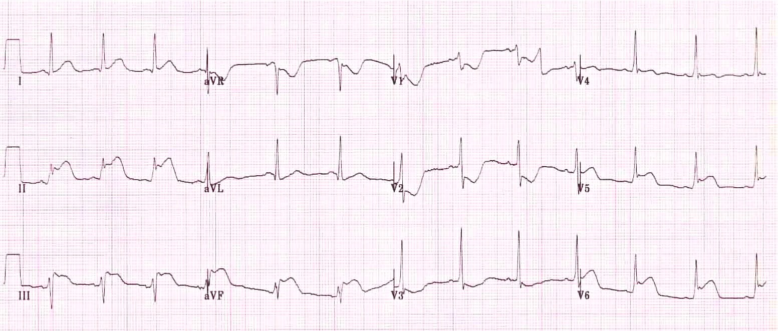ЭКГ при инфаркте нижней, боковой и задней стенок левого желудочка (инфаркт миокарда с подъемом ST).