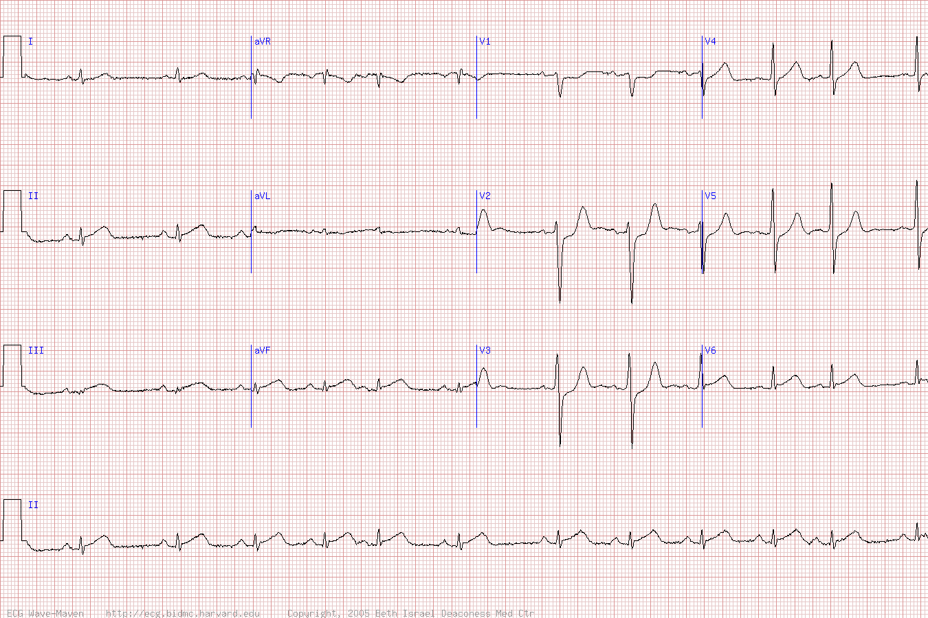 ЭКГ при инфаркте нижней, задней и боковой стенок левого желудочка (инфаркт миокарда с подъемом ST).