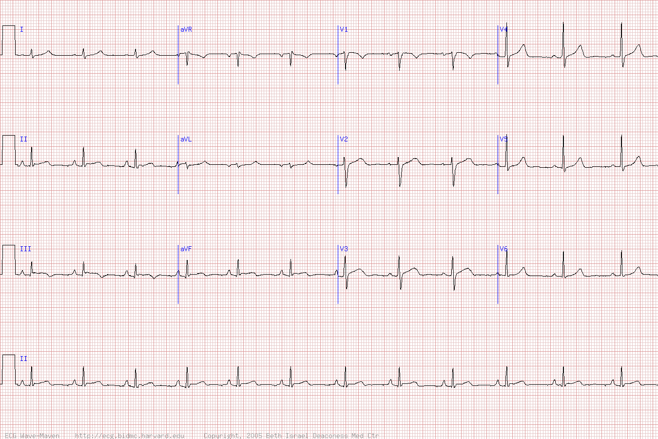 ЭКГ при инфаркте нижней стенки (инфаркт миокарда с подъемом ST).