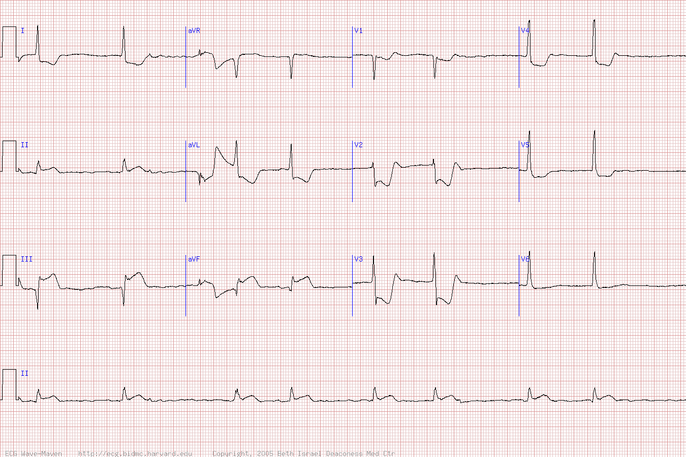 ЭКГ во время острой стадии инфаркта нижней и задней стенок (инфаркт миокарда с подъемом ST).