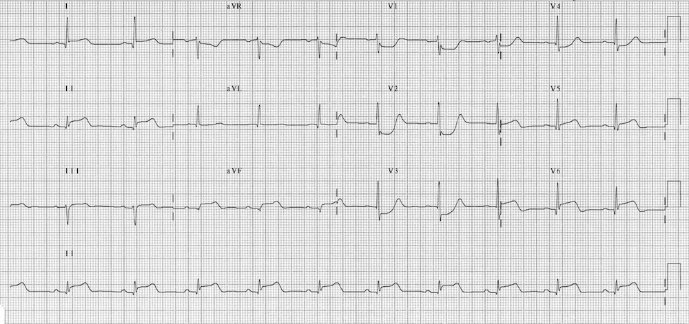 ЭКГ при инфаркте нижней, боковой и задней стенки левого желудочка (инфаркт миокарда с подъемом ST).