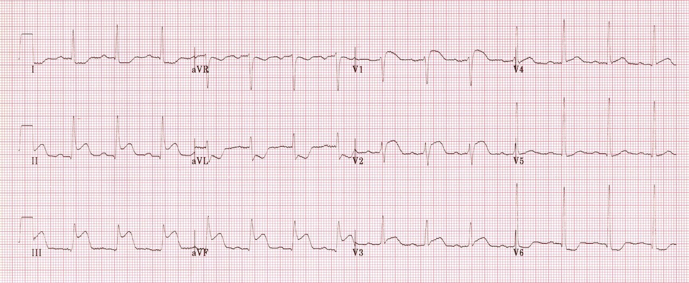 ЭКГ при инфаркте правого желудочка, а также в области нижней и передней стенок левого желудочка (инфаркт миокарда с подъемом ST).
