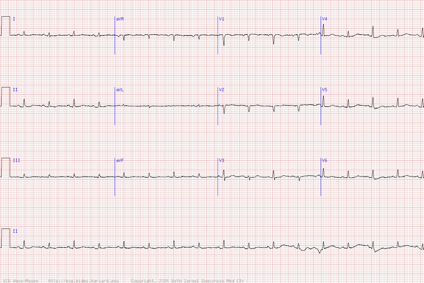 ЭКГ при тампонаде сердца в результате перикардита.