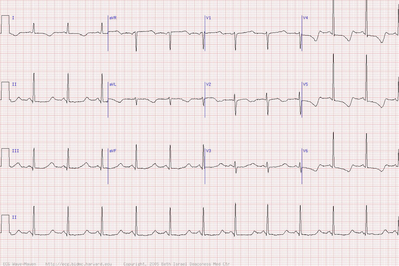 ЭКГ с удлиненным интервалом QT у пациента после реанимации по поводу остановки сердца.
