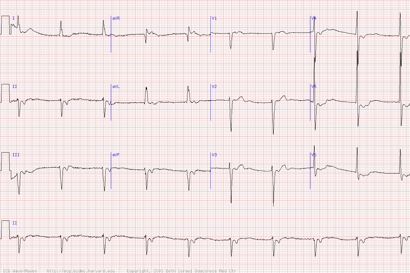 ЭКГ при узловой брадикардии с ретроградным P после QRS.