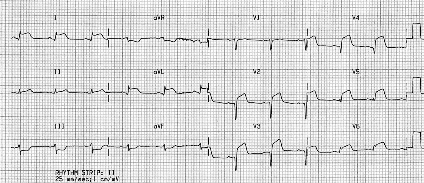Подъем сегмента ST при инфаркте на ЭКГ.