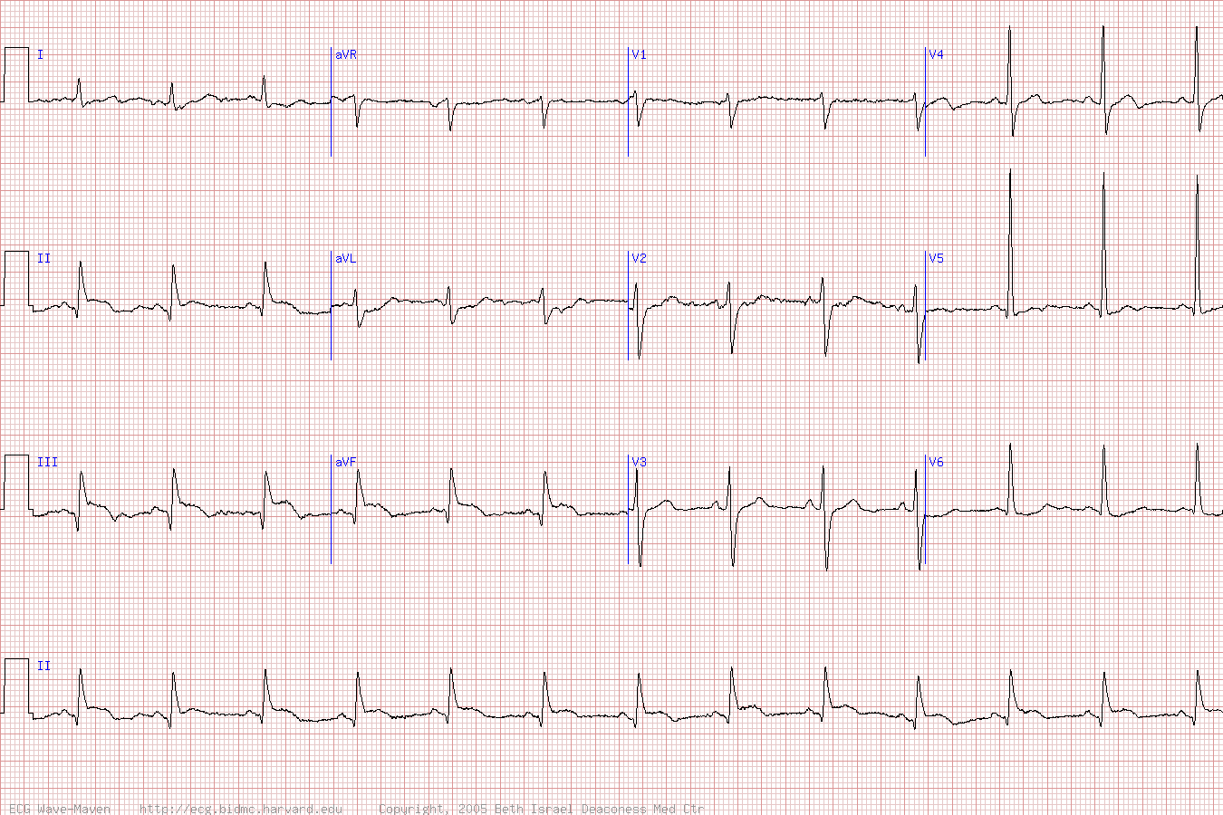 ЭКГ инфаркта нижней стенки с подъемом ST.