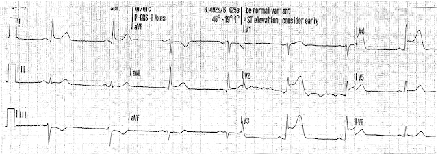 ЭКГ пациента с инфарктом миокарда. 