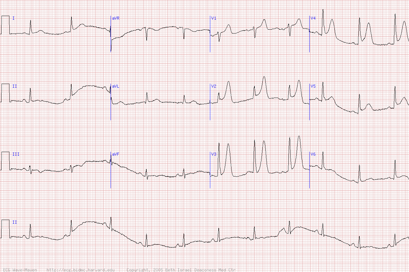 Высокий положительный T в острейшую фазу инфаркта миокарда на ЭКГ.