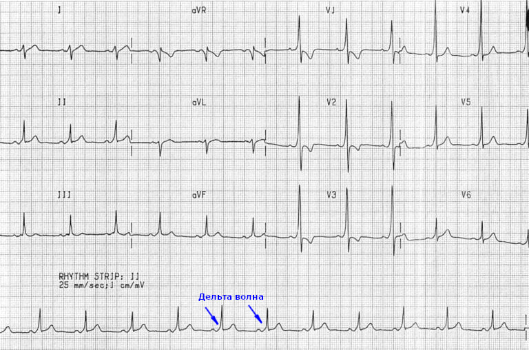Пример кардиограммы с синдромом WPW тип А.