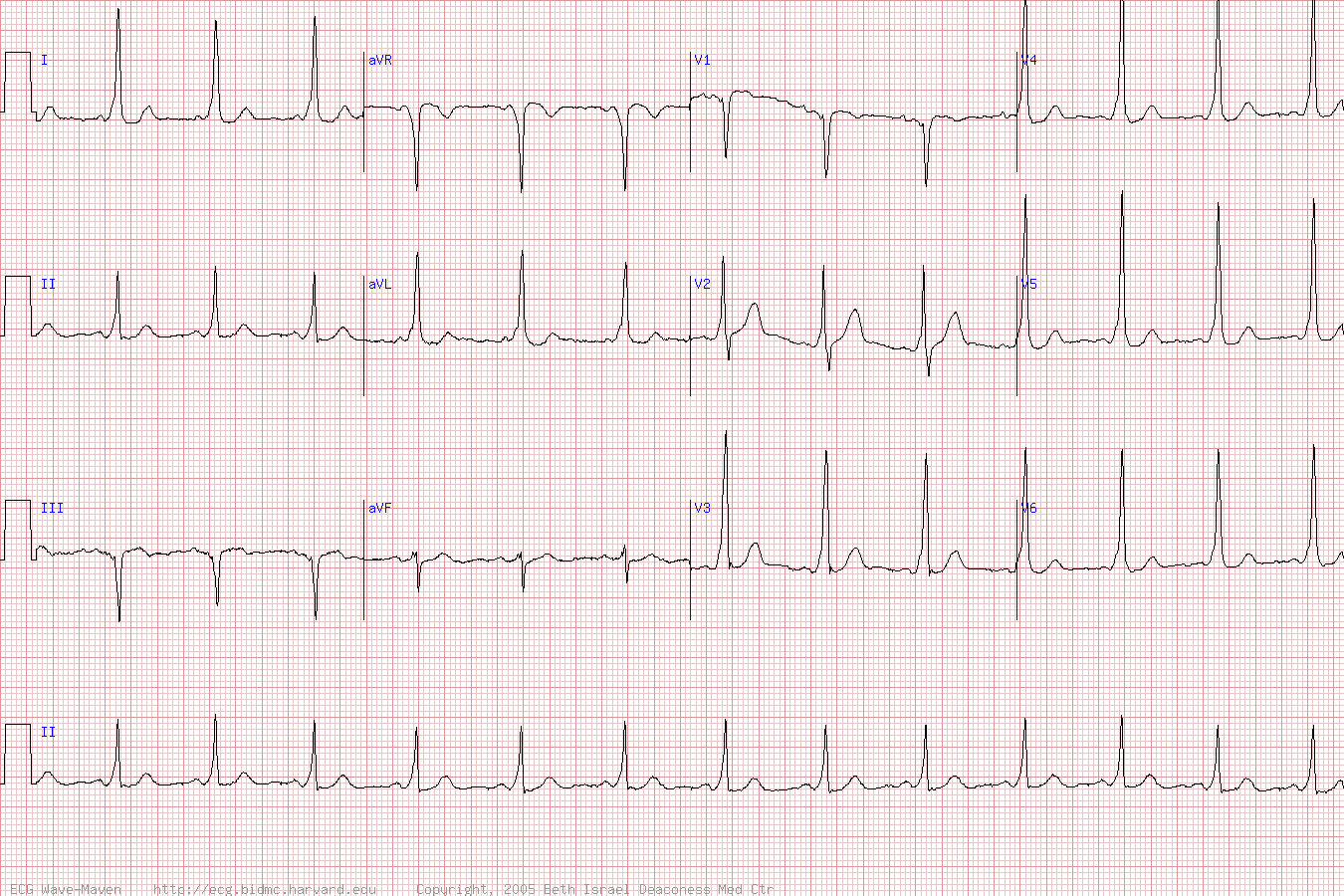 Пример кардиограммы с синдромом WPW.