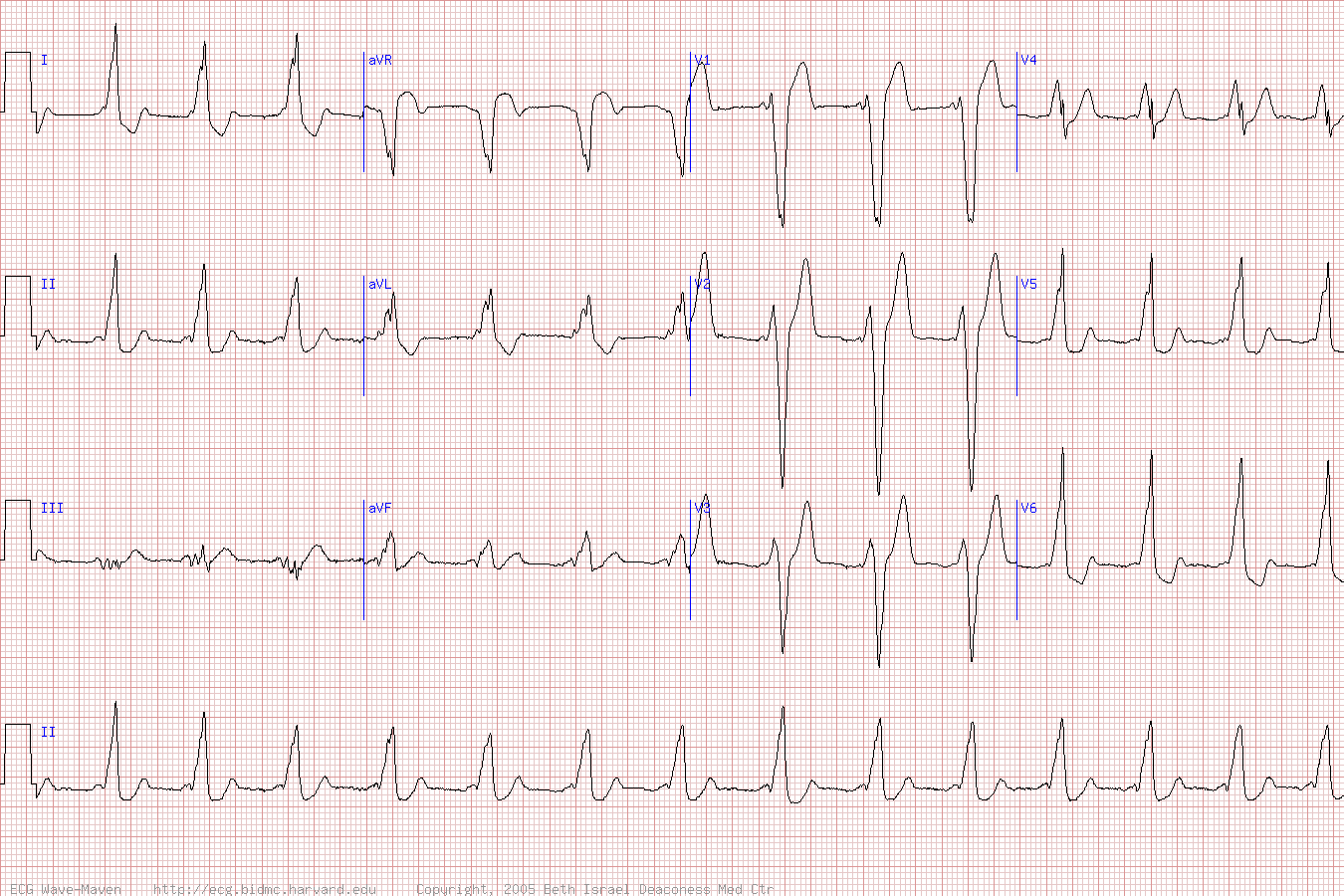 Пример кардиограммы с синдромом WPW тип B.