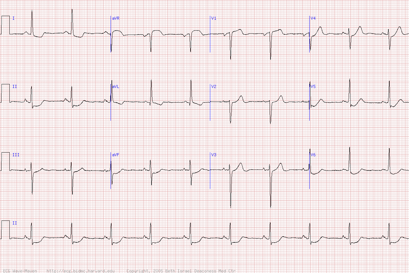 Кардиограмма при инфаркте миокарда без подъема сегмента ST.