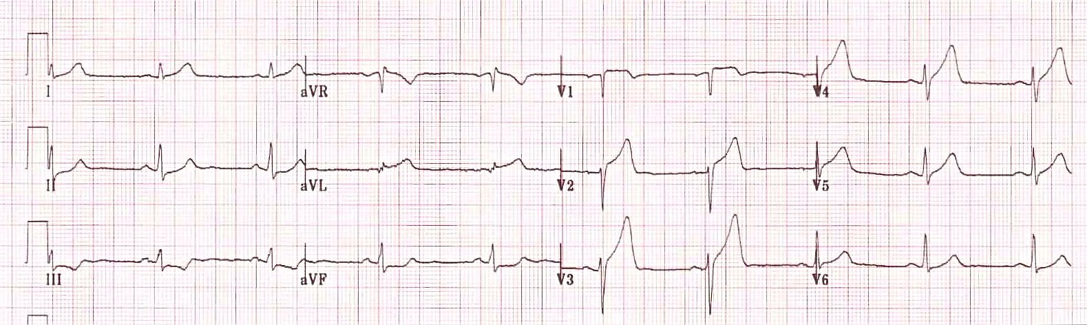 Кардиограмма пациента с острым коронарным синдромом - предположительно инфаркт миокарда.
