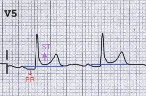 Морфология изменений на кардиограмме при перикардите.