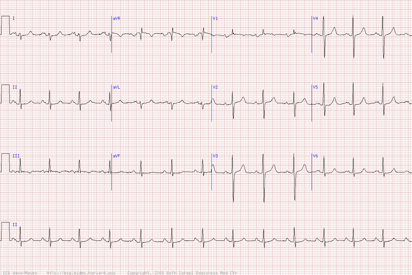 Пример кардиограммы с гипертрофией правого желудочка.