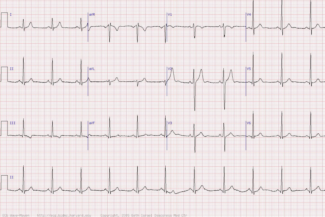 Пример кардиограммы без отклонений от нормы.