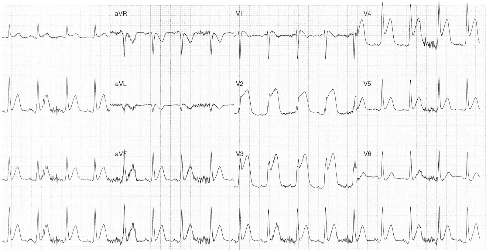 Инфаркт с подъемом ST на кардиограмме.