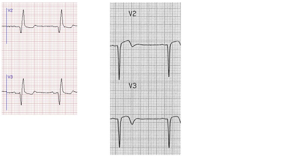 Фрагменты кардиограмм с постинфарктными изменениями.