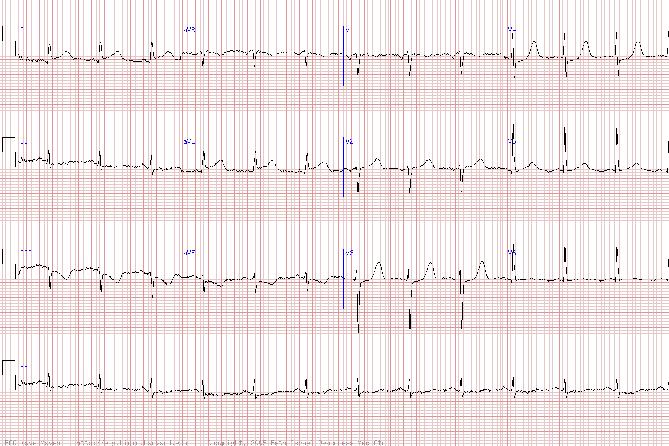 ЭКГ при высоком боковом инфаркте
