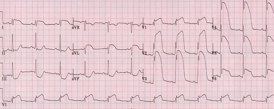 ЭКГ при обширном инфаркте передней стенки.