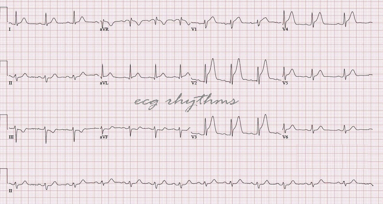 Кардиограмма при инфаркте с подъемом сегмента ST.