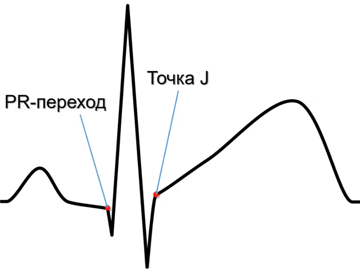 Классификация инфаркта миокарда с подъемом сегмента st
